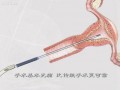 立可灵一次性宫腔组织吸引管