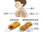 运动性哮喘吃什么药？郑州那家医院治疗运动性哮喘好？